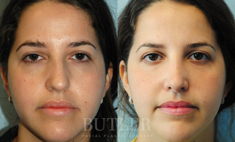 Rhinoplasty Before and After Patient 1
