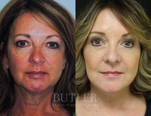 Facelift Before and After Patient Thumbnail 1