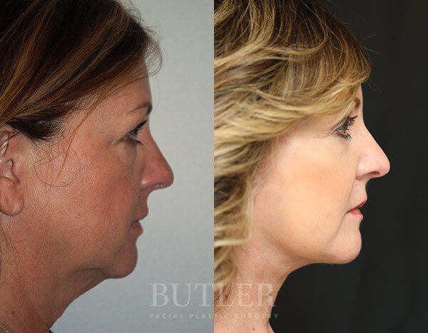 Facelift Before and After Patient 3