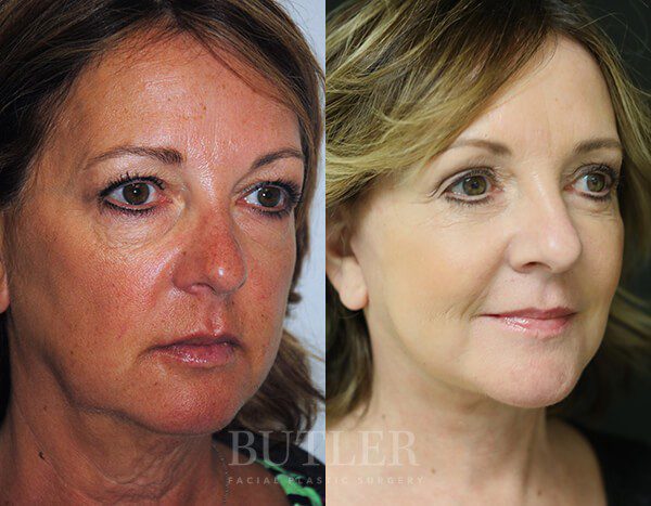 Facelift Before and After Patient 2