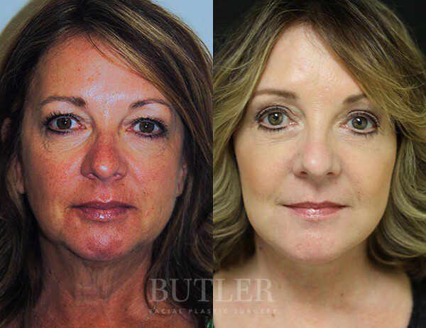 Facelift Before and After Patient 1