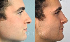 Rhinoplasty Before and After Patient Thumbnail 2