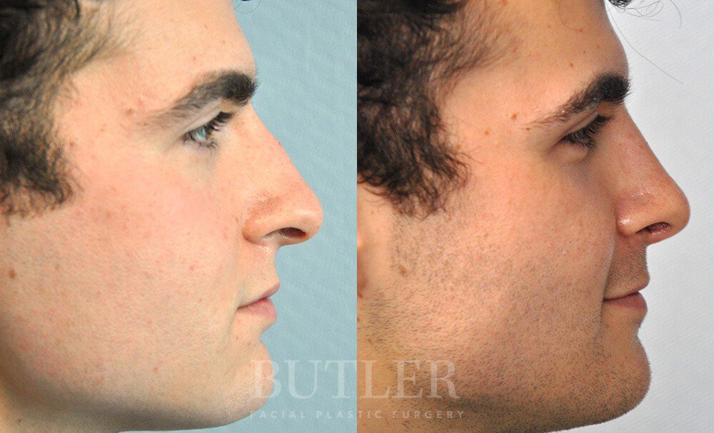 Rhinoplasty Before and After Patient 2