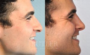 Rhinoplasty Before and After Patient Thumbnail 3