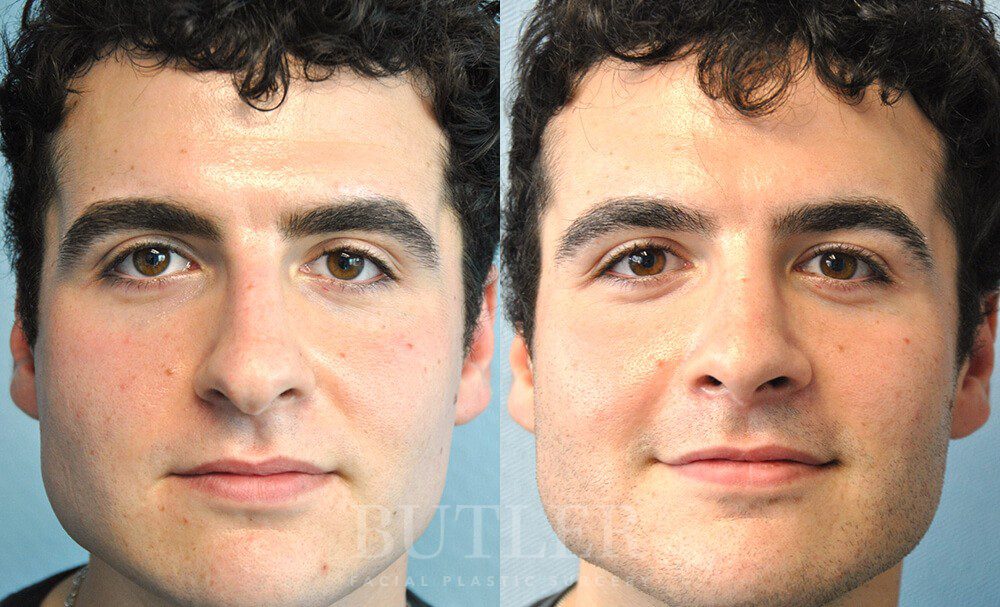 Rhinoplasty Before and After Patient 1