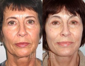 Facelift Before and After Patient Thumbnail 1