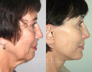 Facelift Before and After Patient Thumbnail 3
