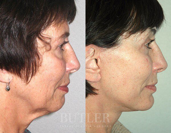 Facelift Before and After Patient 3