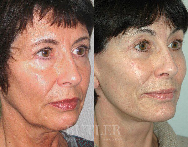 Facelift Before and After Patient 2