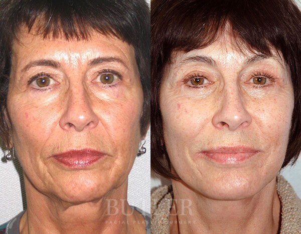 Facelift Before and After Patient 1