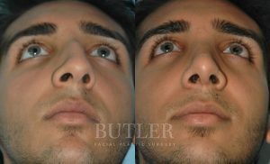 Rhinoplasty Before and After Patient Thumbnail 2