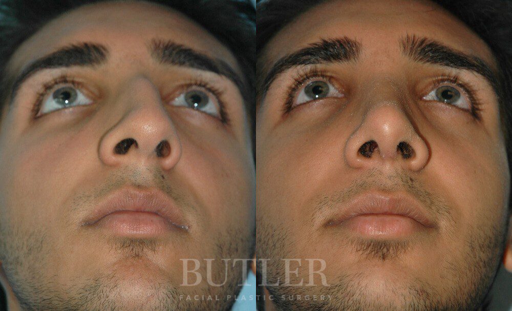 Rhinoplasty Before and After Patient 2