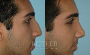 Rhinoplasty Before and After Patient Thumbnail 3