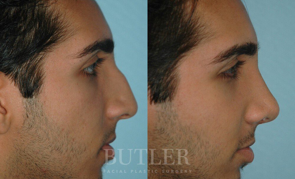 Rhinoplasty Before and After Patient 3
