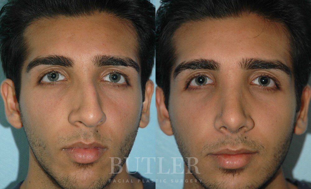 Rhinoplasty Before and After Patient 1