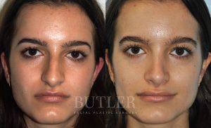 Rhinoplasty Before and After Patient Thumbnail 1