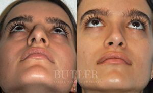 Rhinoplasty Before and After Patient Thumbnail 2