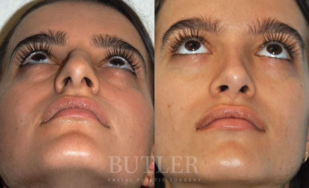 Rhinoplasty Before and After Patient 2