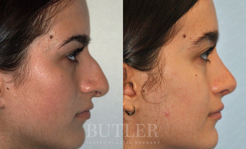 Rhinoplasty Before and After Patient 4