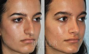 Rhinoplasty Before and After Patient Thumbnail 3