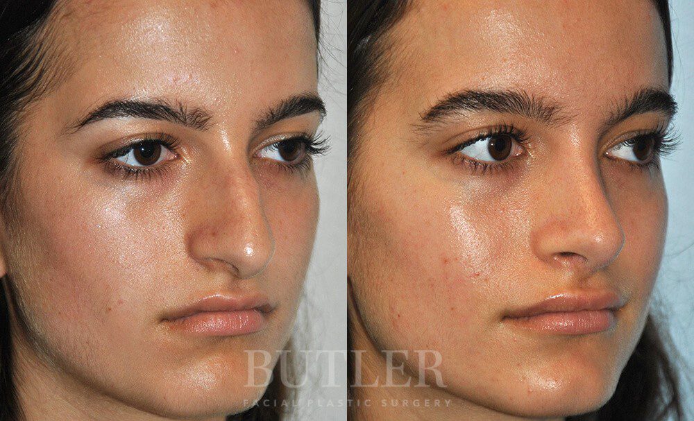 Rhinoplasty Before and After Patient 3