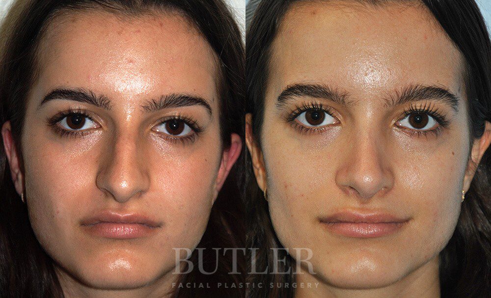 Rhinoplasty Before and After Patient 1